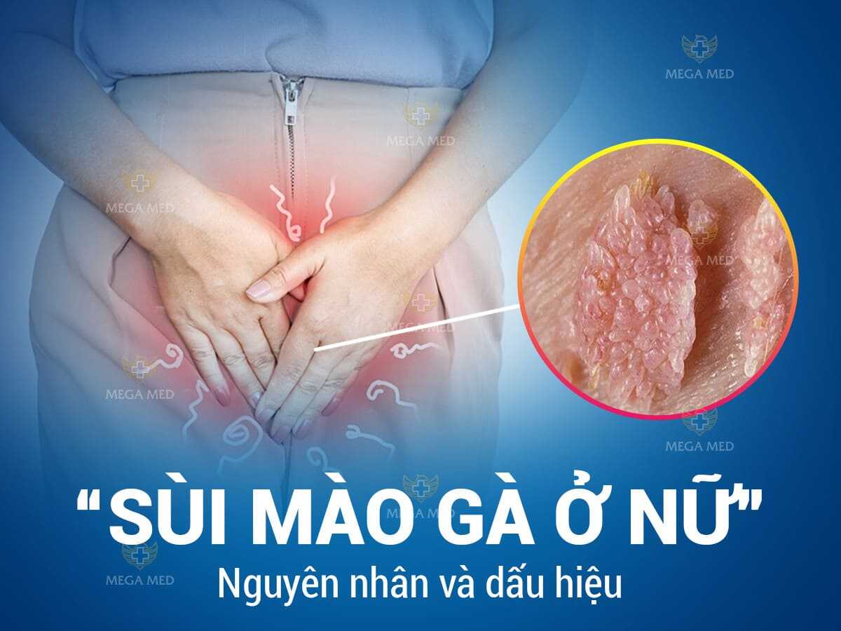 Hình ảnh sùi mào gà ở nữ